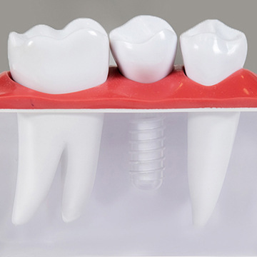 Dental Implants