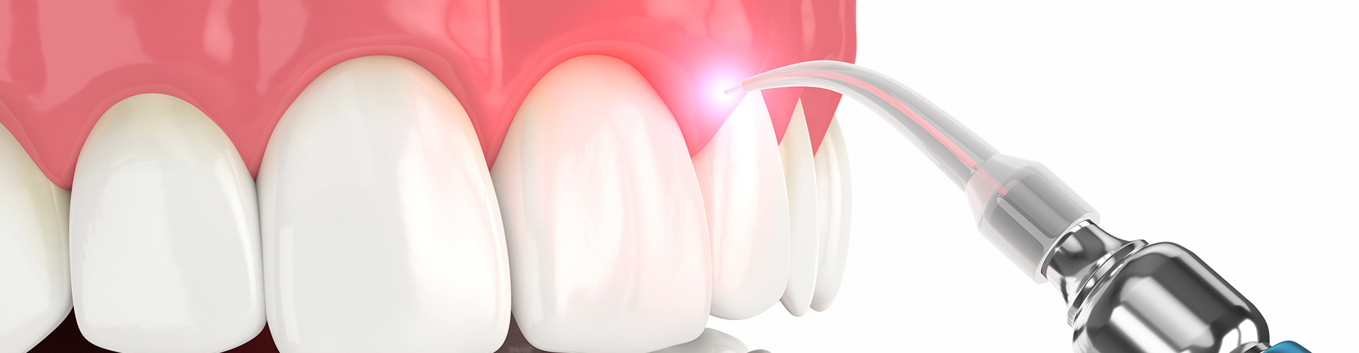 Laser Dental Technology