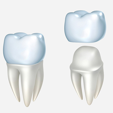 Same-day CEREC Crowns