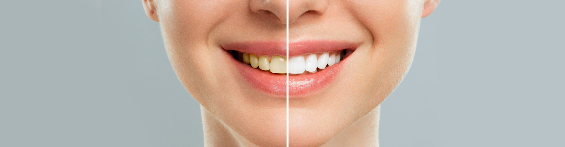 Teeth Whitening