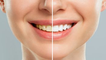 Top 5 Benefits of Professional Teeth Whitening for Mesa Patients