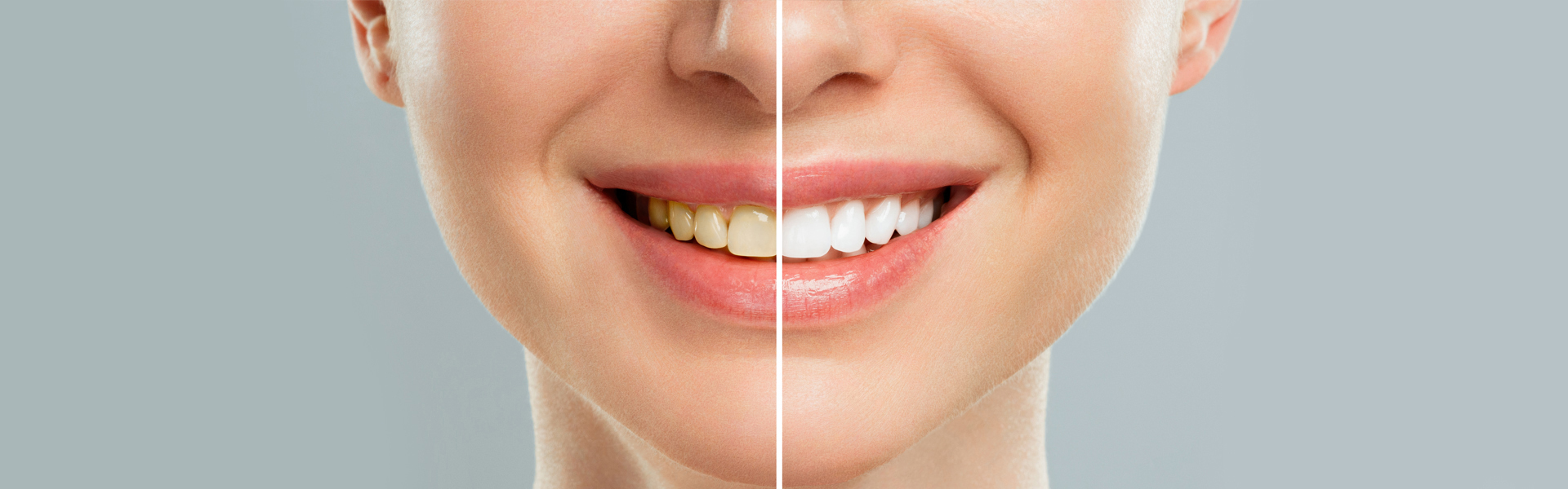 Top 5 Benefits of Professional Teeth Whitening for Mesa Patients