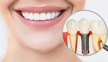 Why Dental Implants Are the Gold Standard for Tooth Replacement in Mesa & Gilbert, AZ?