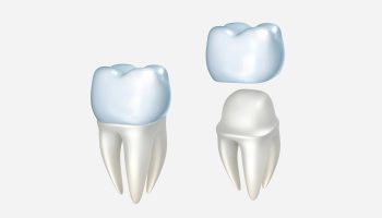 How Advanced Dental Technology Is Improving Dental Crowns in Mesa, AZ